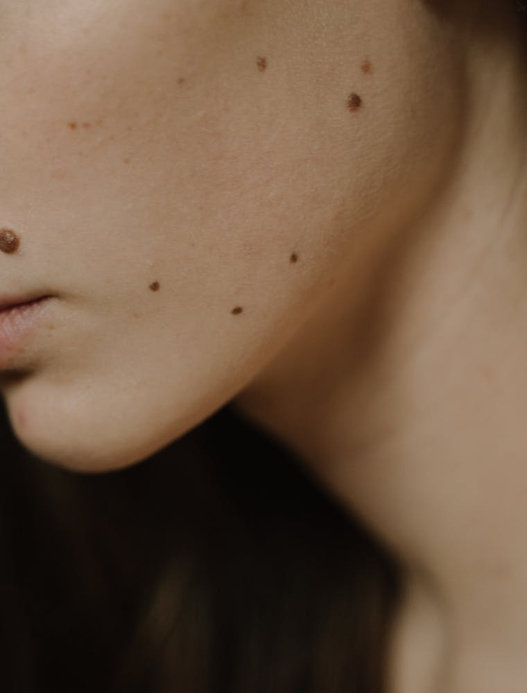 Yüzde ben ve leke - dermatolojik nevüs incelemesi
